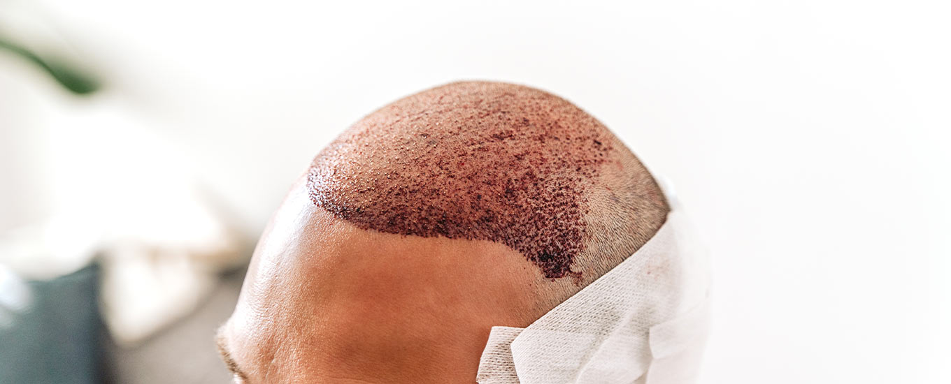 hairtransplant-s