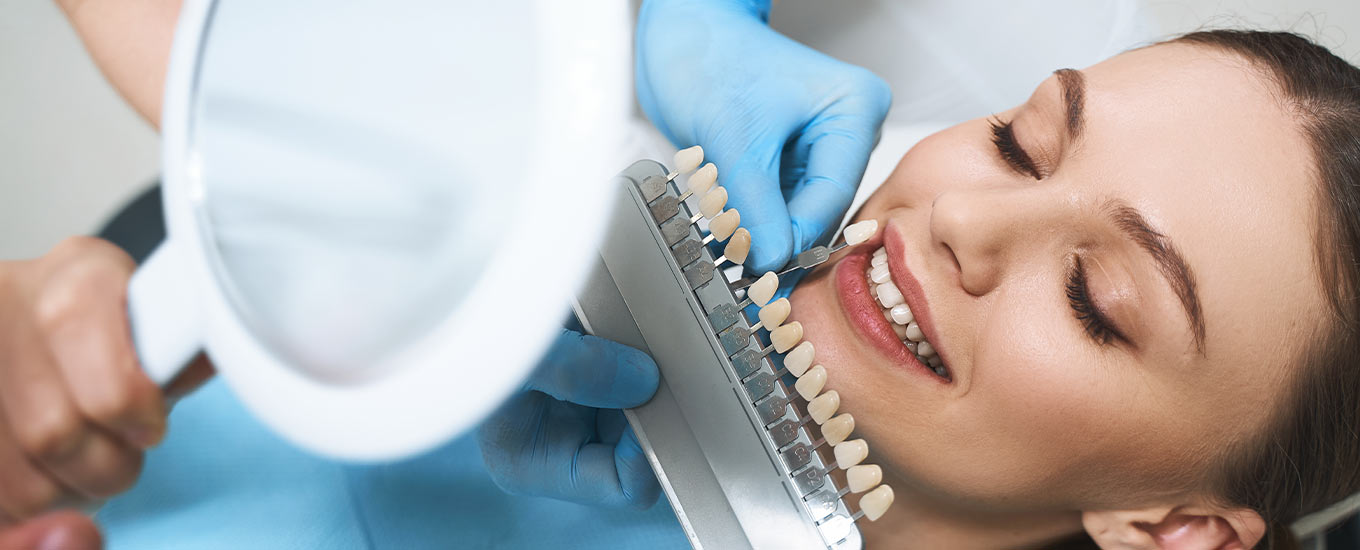 veneers